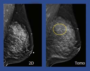 Digital 3D Mammography (Tomosynthesis) image